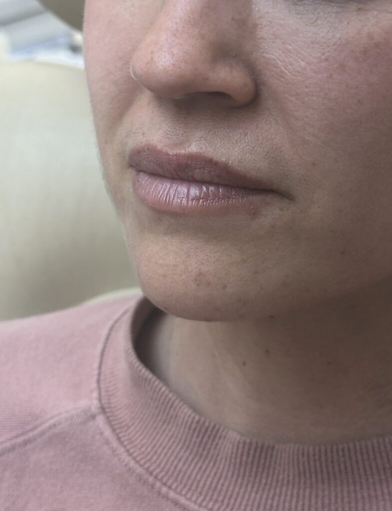 Before photo of lips prior to lip filler dermal filler injection treatment at MiraMed Day Spa Santa Barbara California
