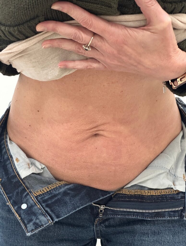 Before photo of abdomen prior to Venus Legacy skin tightening body contouring treatment at MiraMed Day Spa Santa Barbara California